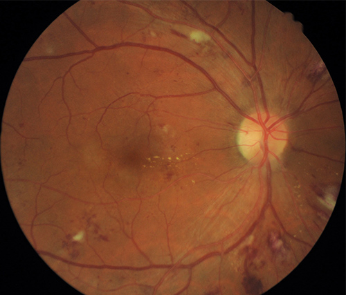 The retina of an individual with diabetes showing signs of diabetic retinopathy