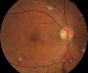 right eye retina of diabetes patient with  diabetic retinopathy